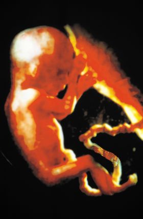 Babies Aborted for “Minor Defects”