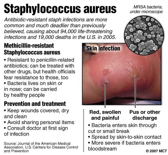 Staph Infection On Outside Of Nose